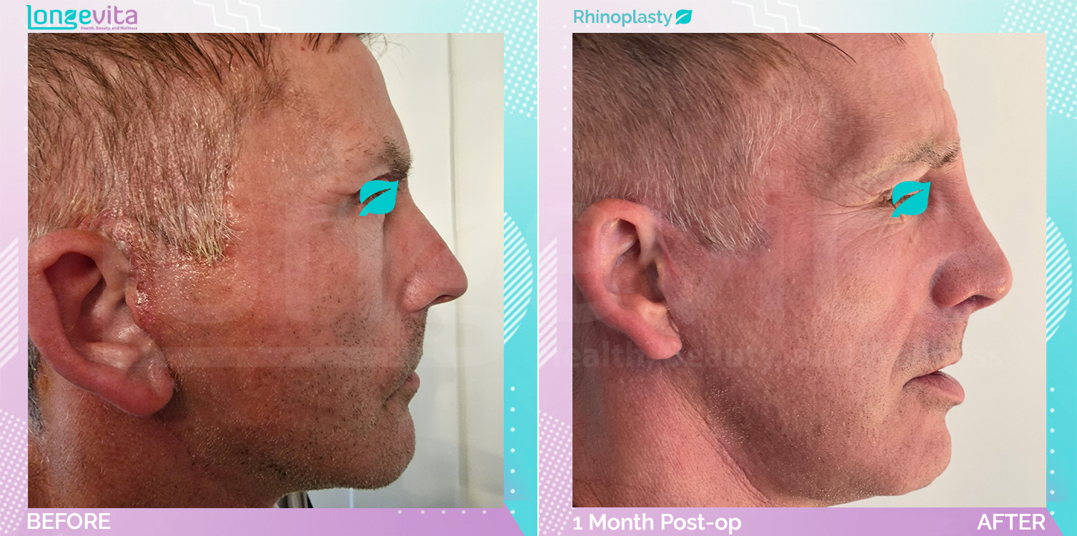 Rhinoplasty before and after, Face, 50s male patient
