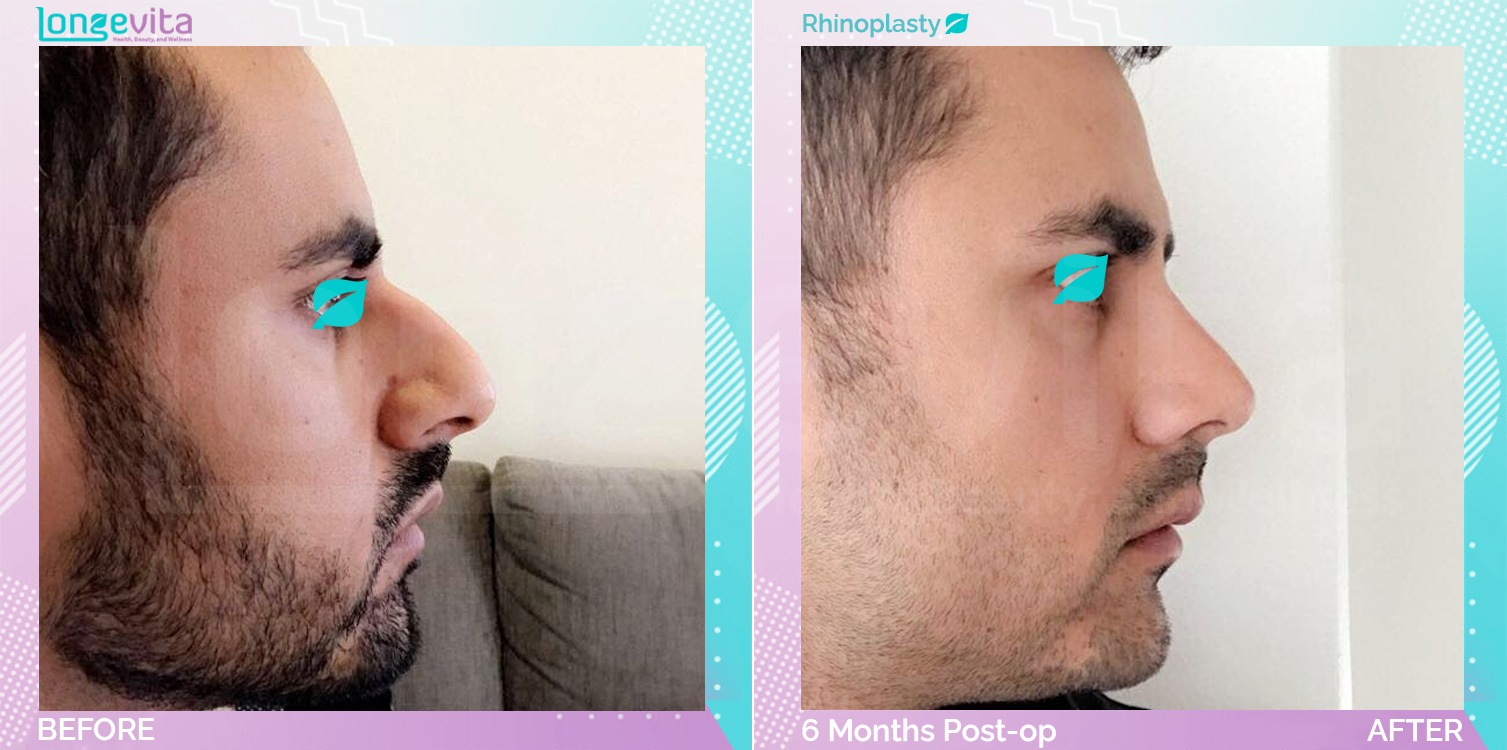 Rhinoplasty before and after, Face