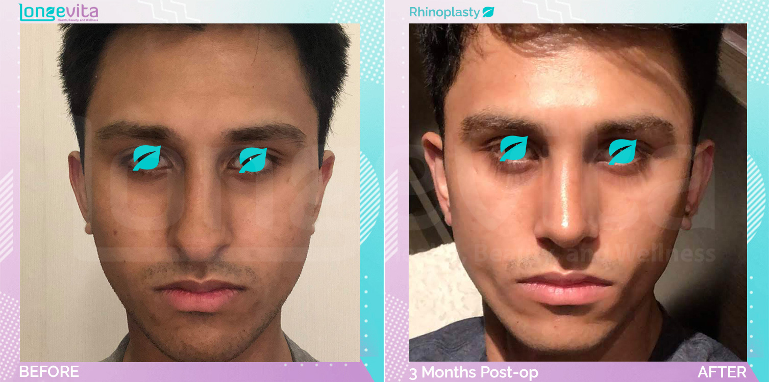 Rhinoplasty before and after, Face, 10s male patient