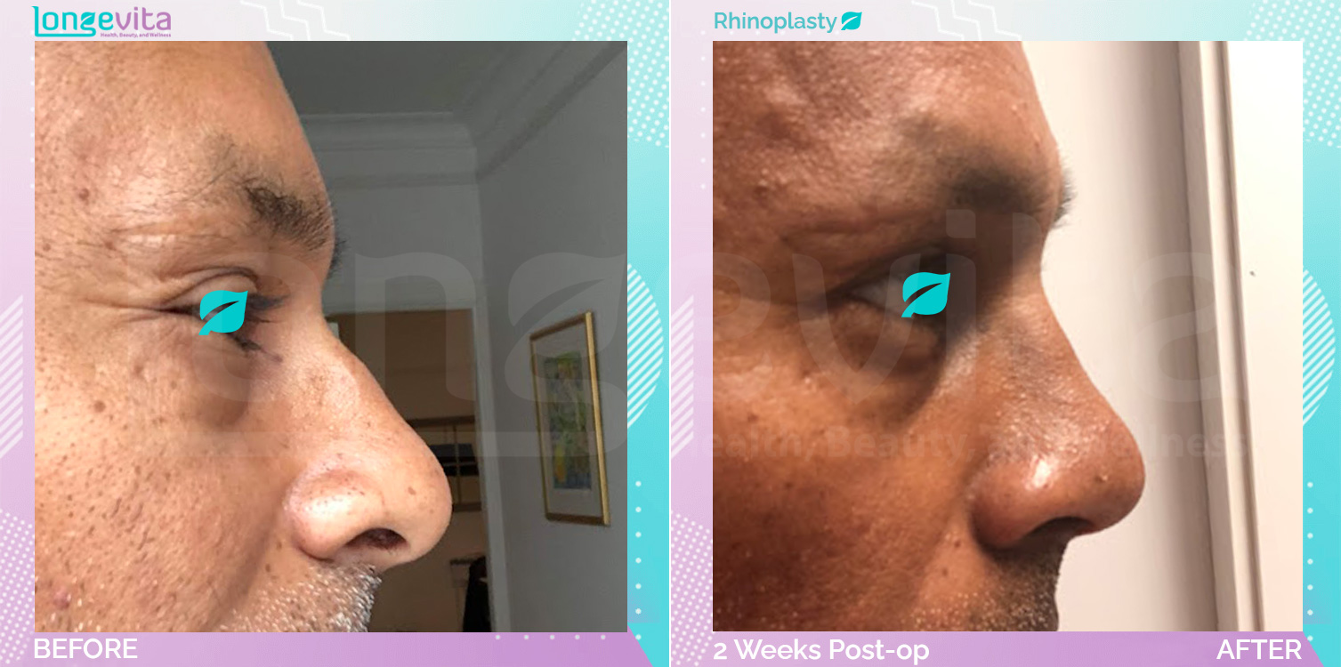 Rhinoplasty before and after, Face, 50s male patient