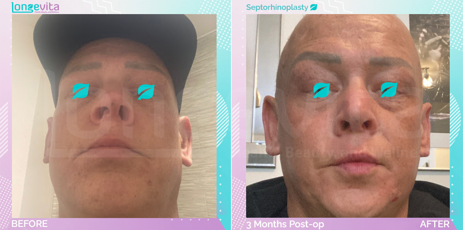 Septorhinoplasty before and after, Face, 30s male patient