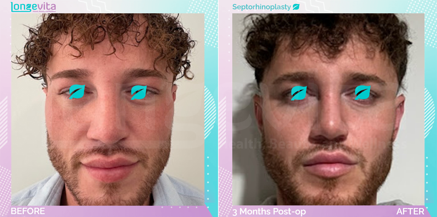 Septorhinoplasty before and after, Face, 20s male patient