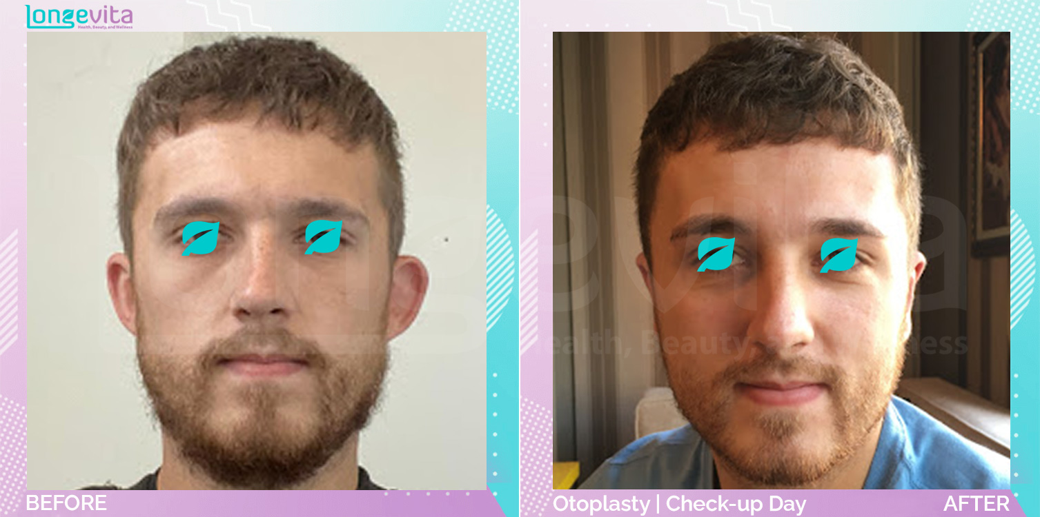 Otoplasty before and after, Face, 20s male patient