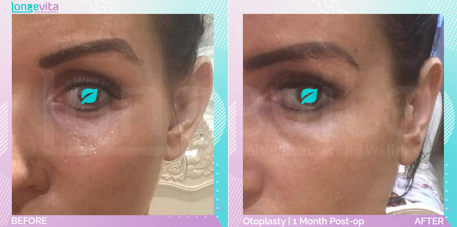 Otoplasty before and after, Face