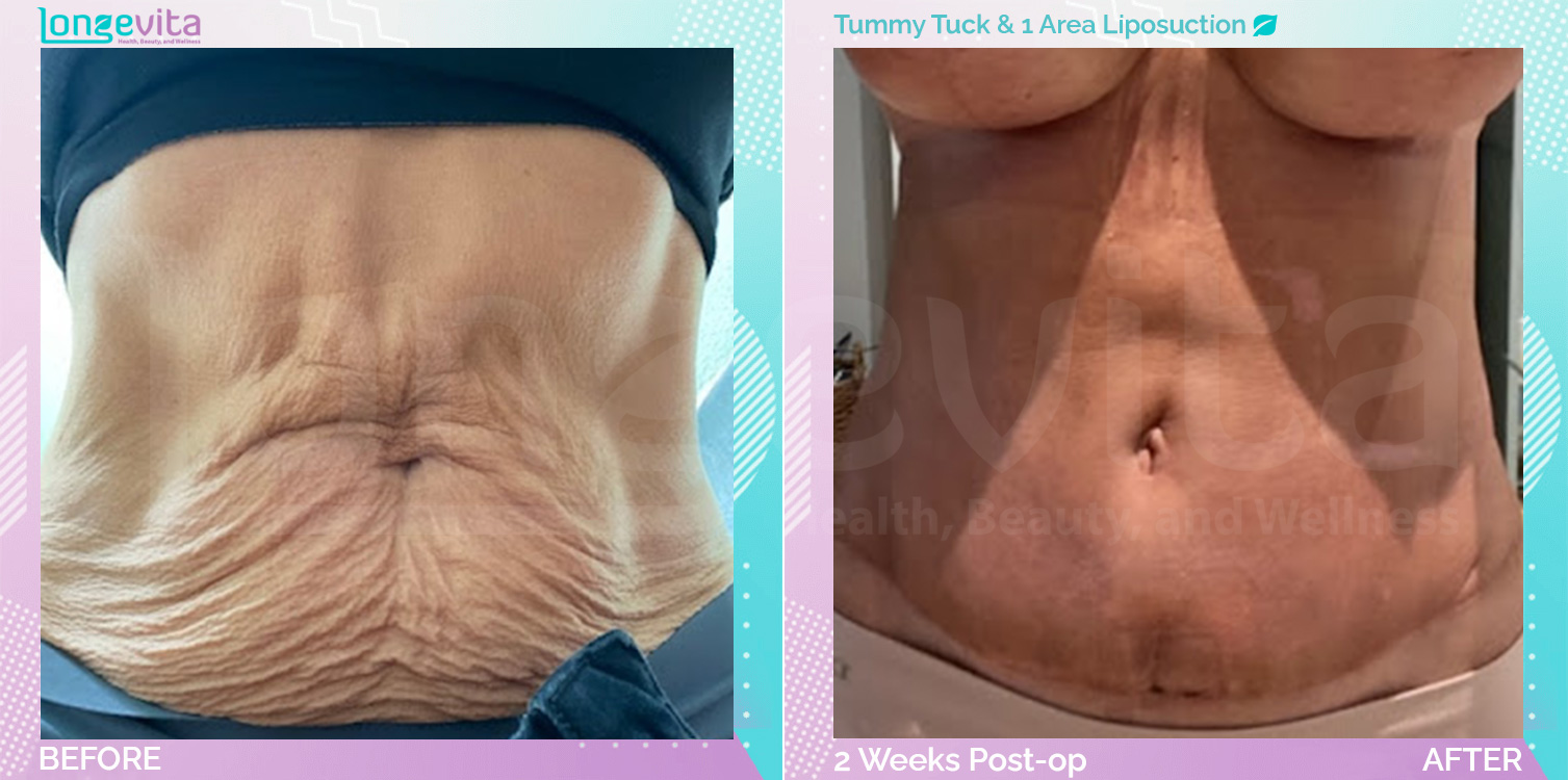 Liposuction and Tummy Tuck before and after, Body, 50s female patient