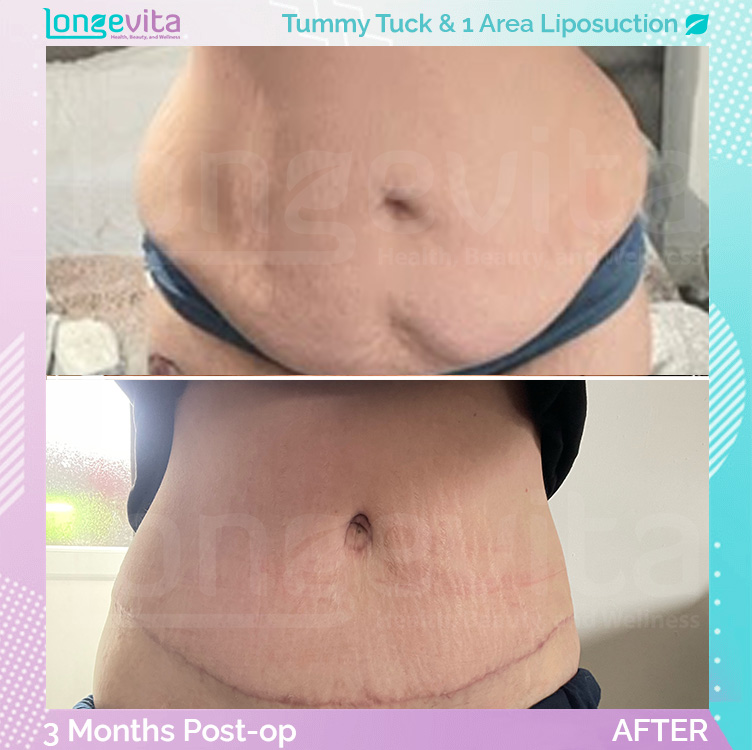 Liposuction and Tummy Tuck before and after, Body, 30s female patient