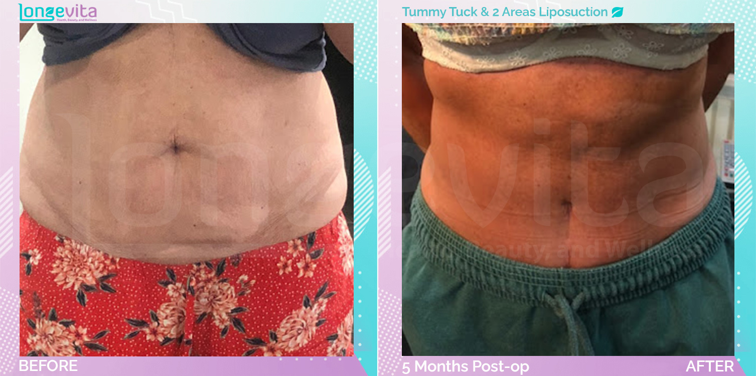 Liposuction and Tummy Tuck before and after, Body, 60s female patient