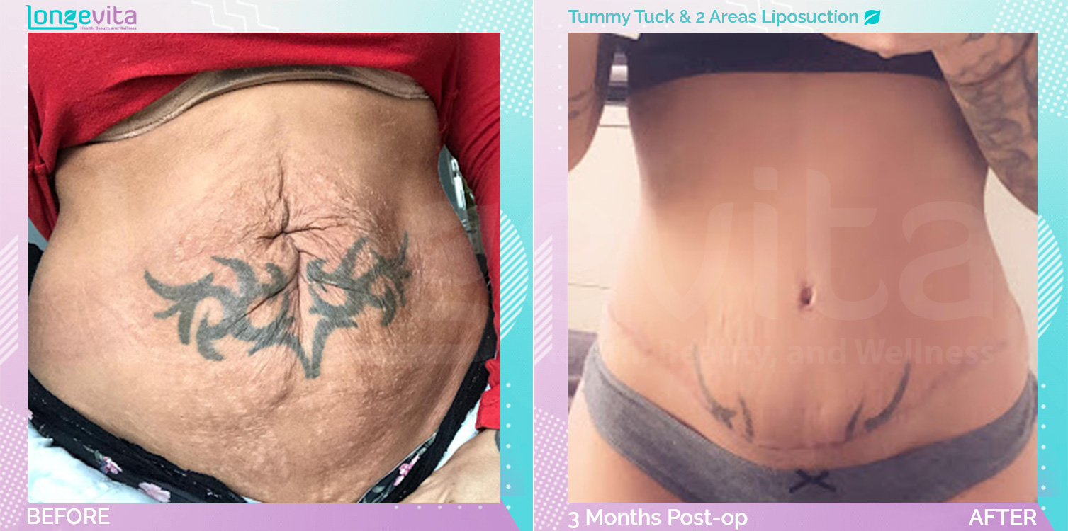 Liposuction and Tummy Tuck before and after, Body, 30s female patient