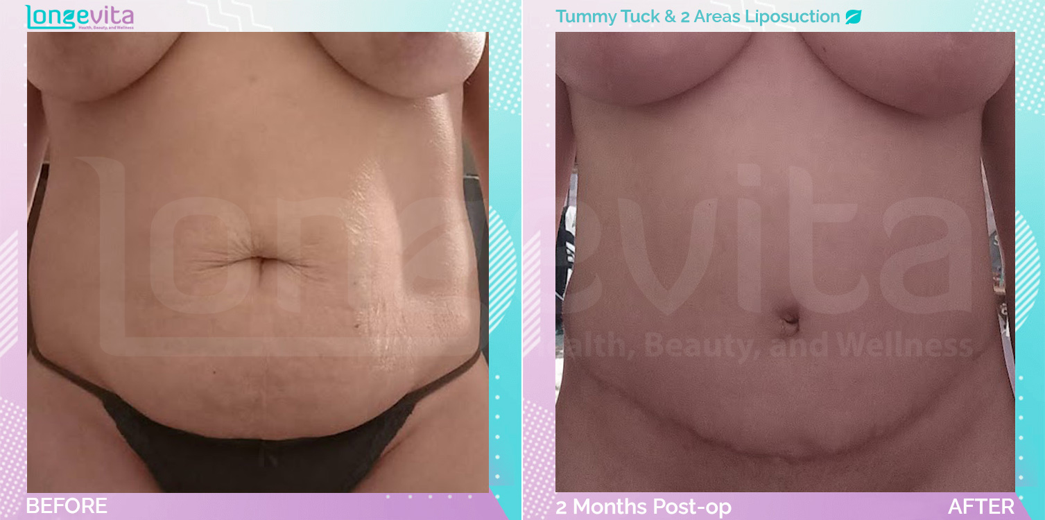 Liposuction and Tummy Tuck before and after, Body, 30s female patient