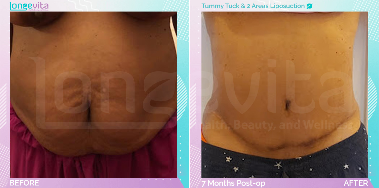 Liposuction and Tummy Tuck before and after, Body, 50s female patient