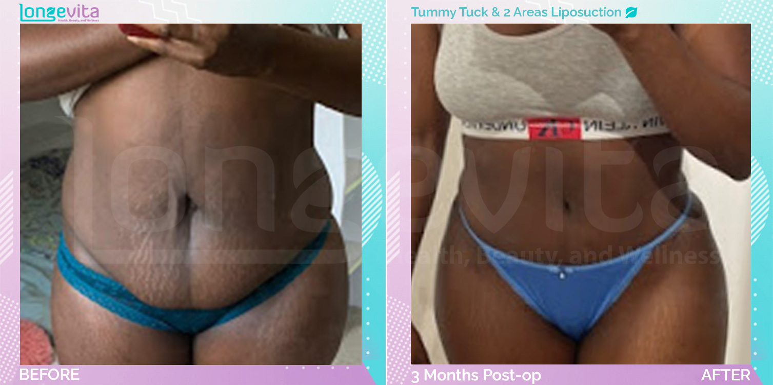 Liposuction and Tummy Tuck before and after, Body, 30s female patient