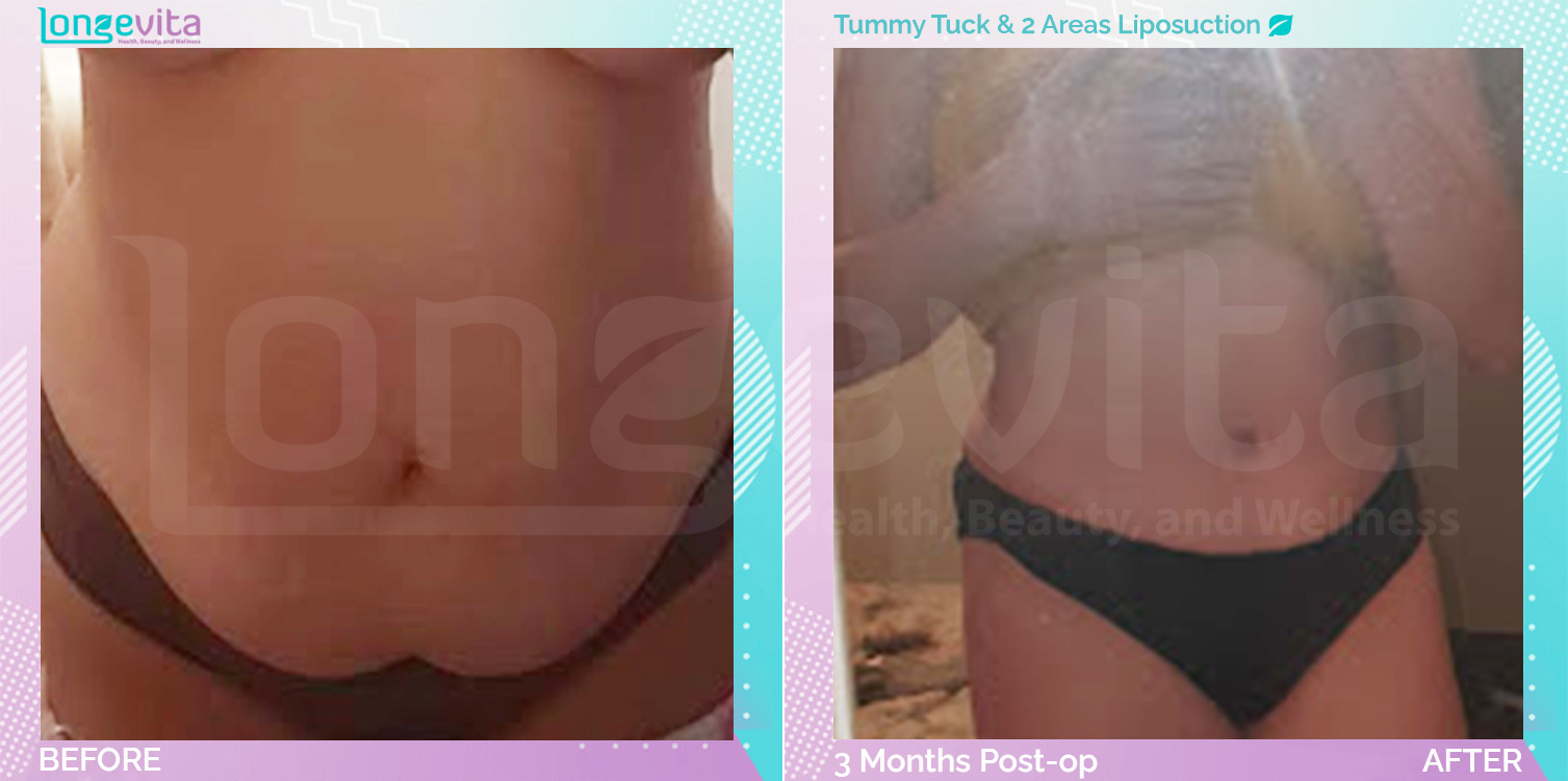 Liposuction and Tummy Tuck before and after, Body, 30s female patient
