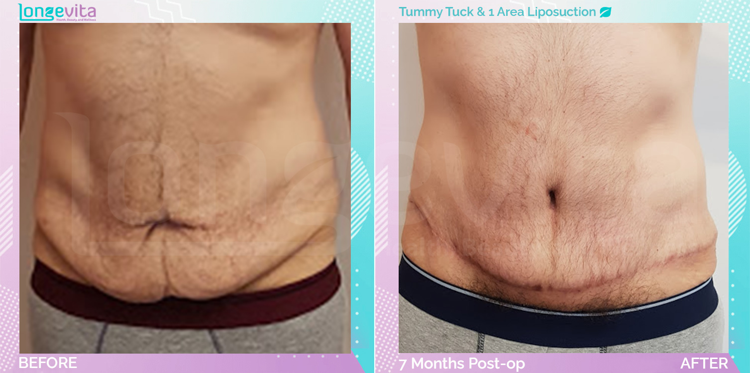 Liposuction and Tummy Tuck before and after, Body, 40s male patient