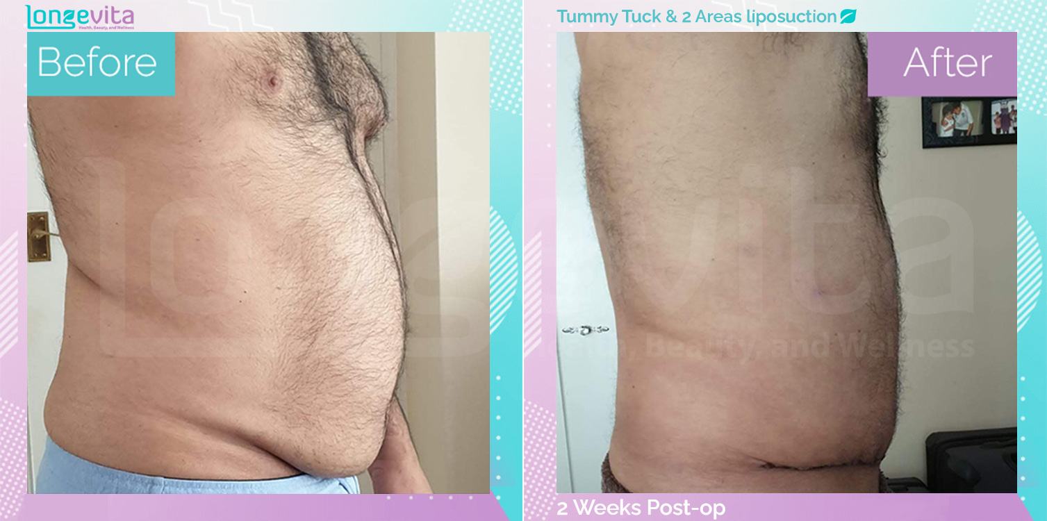 Liposuction and Tummy Tuck before and after, Body, 50s male patient