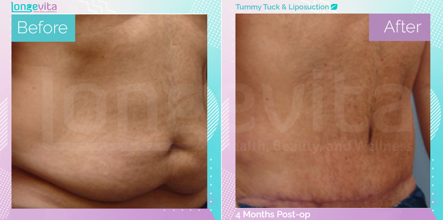 Liposuction and Tummy Tuck before and after, Body