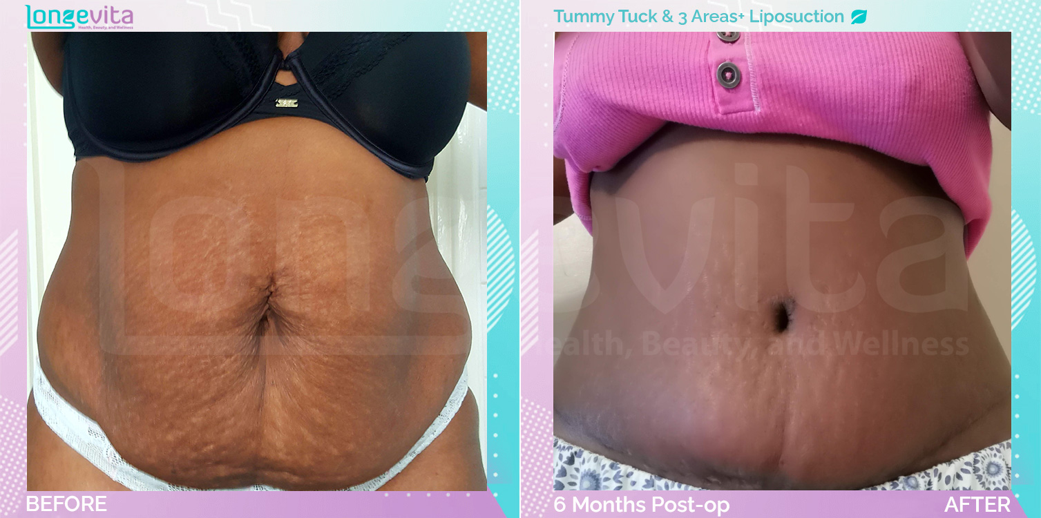 Liposuction and Tummy Tuck before and after, Body