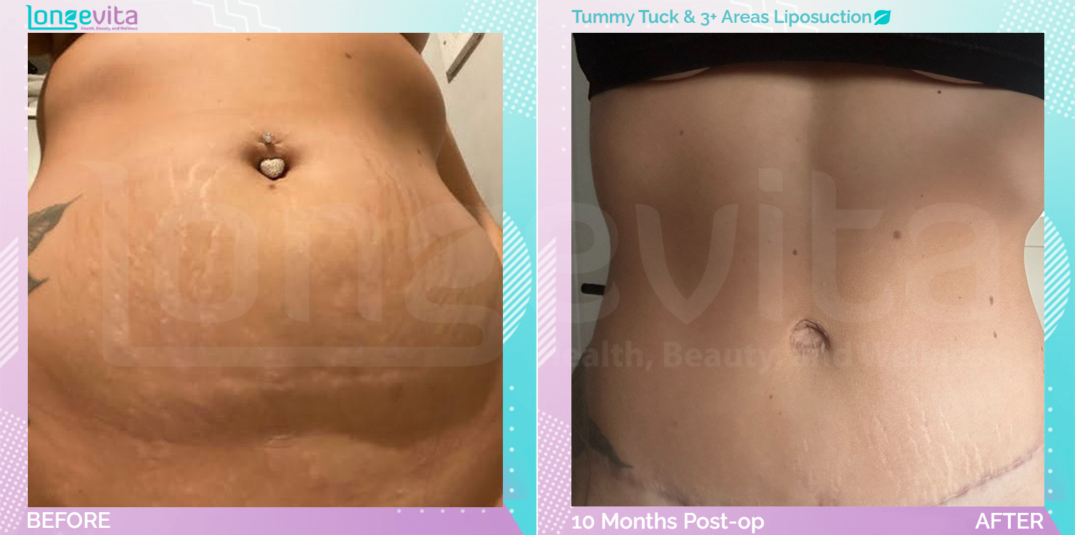 Liposuction and Tummy Tuck before and after, Body, 20s female patient