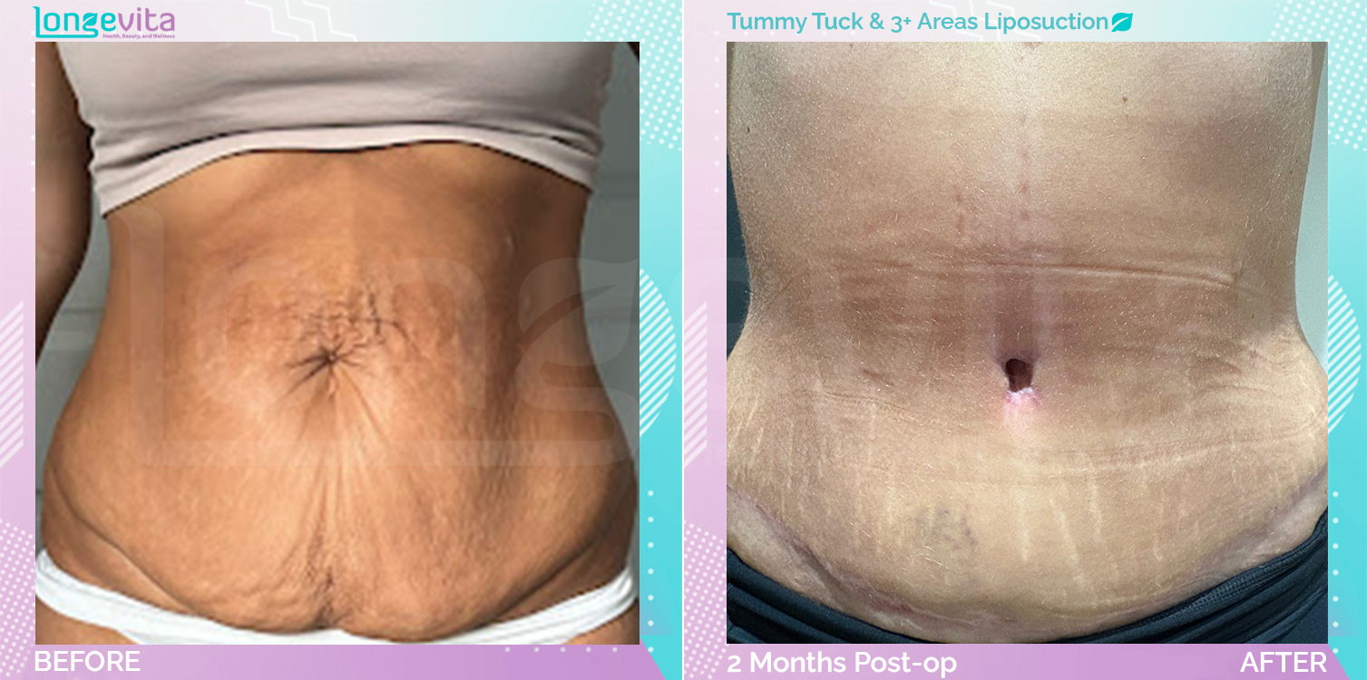 Liposuction and Tummy Tuck before and after, Body, 30s female patient