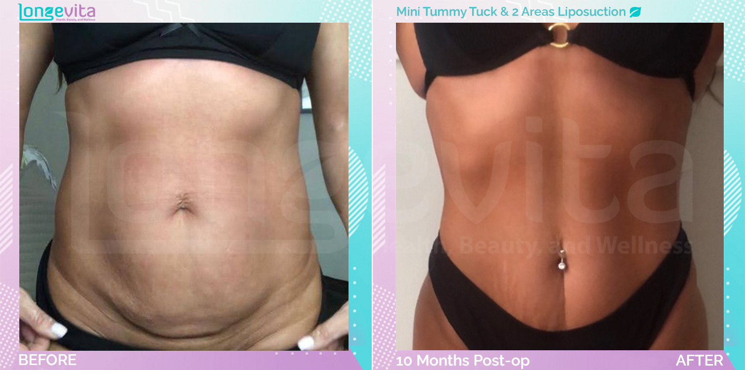 Liposuction and Tummy Tuck before and after, Body, 40s female patient