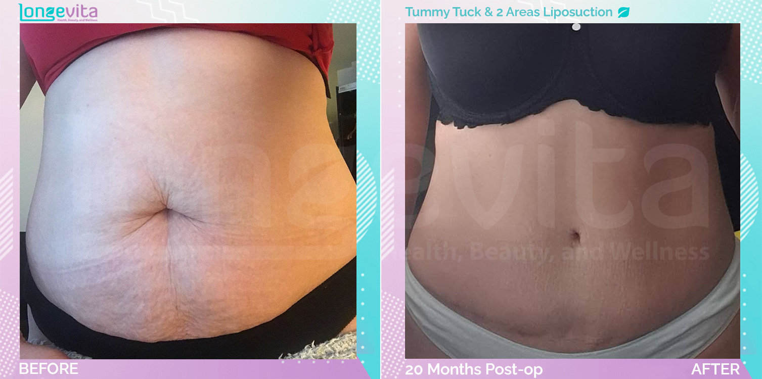 Liposuction and Tummy Tuck before and after, Body, 30s female patient
