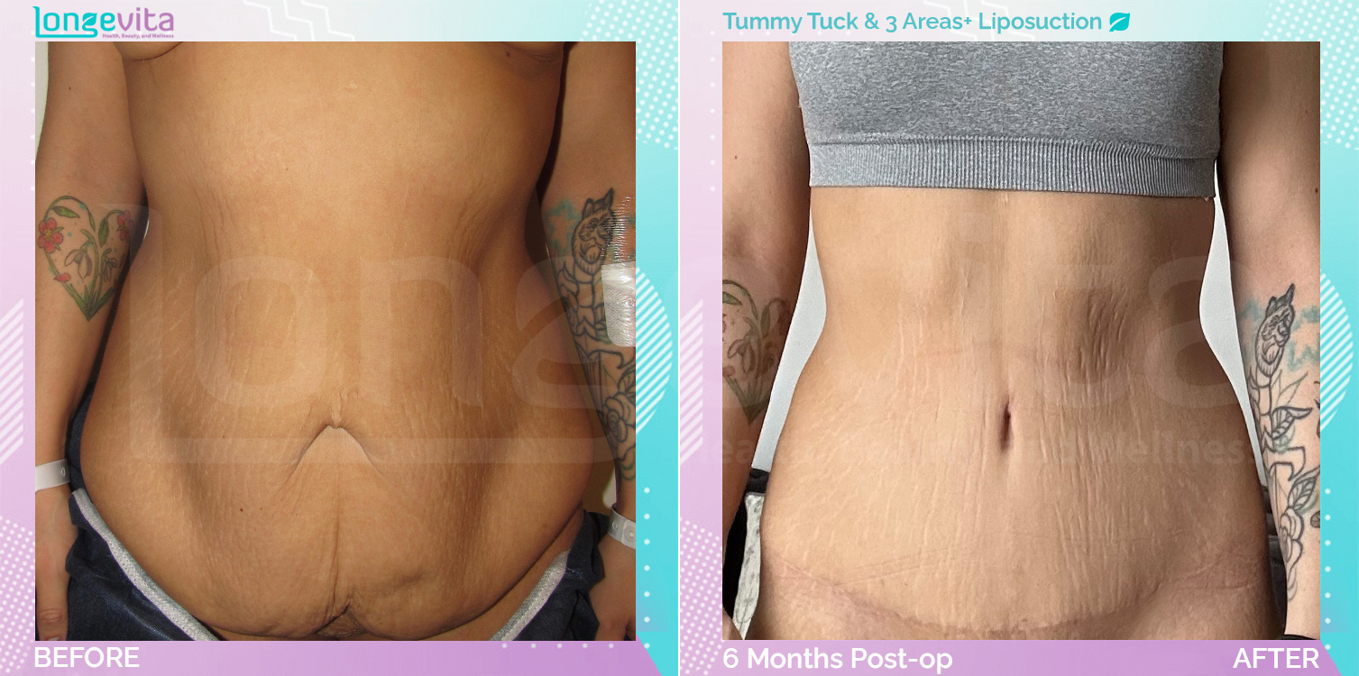 Liposuction and Tummy Tuck before and after, Body, 20s female patient