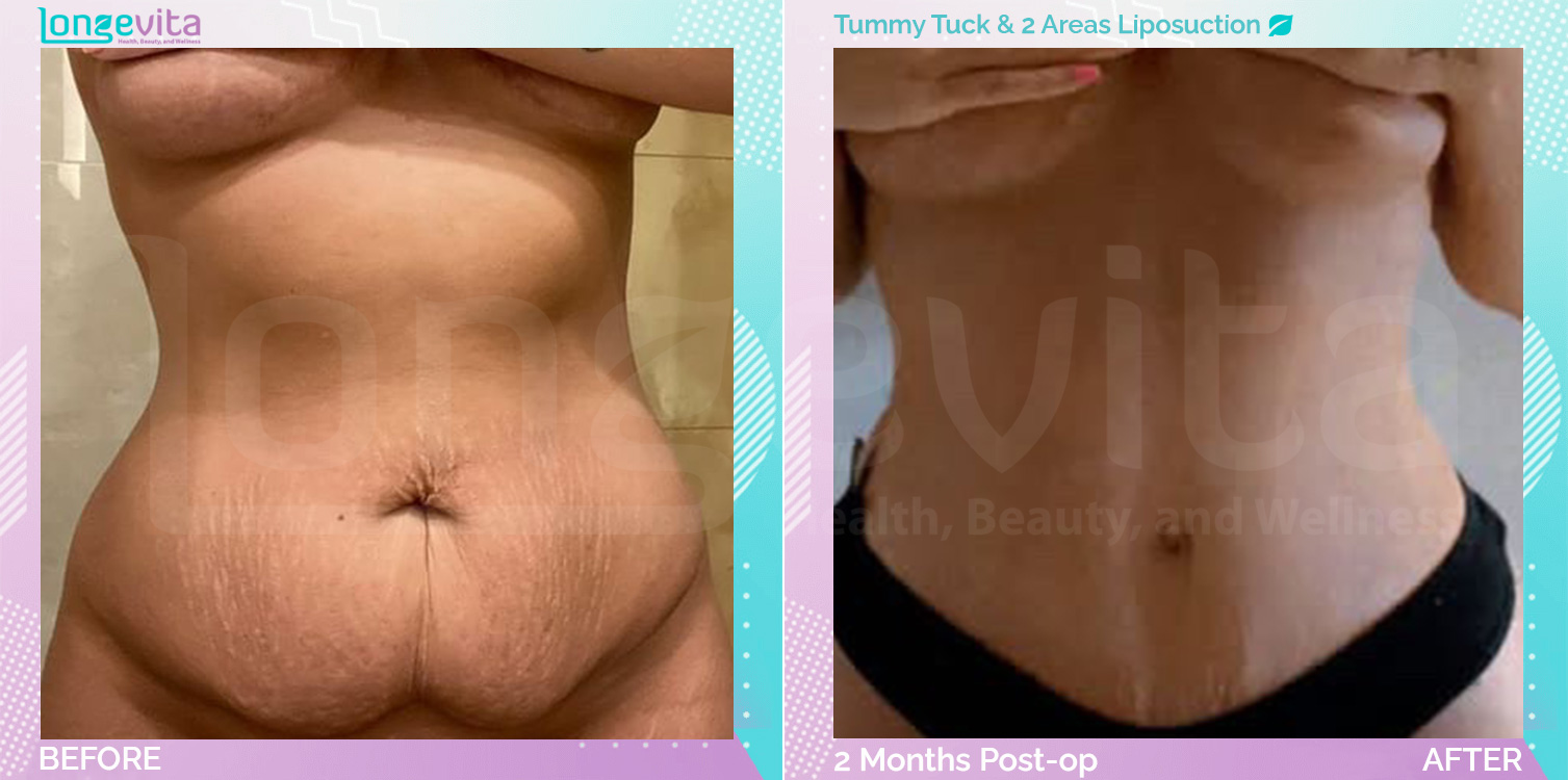Liposuction and Tummy Tuck before and after, Body, 20s female patient