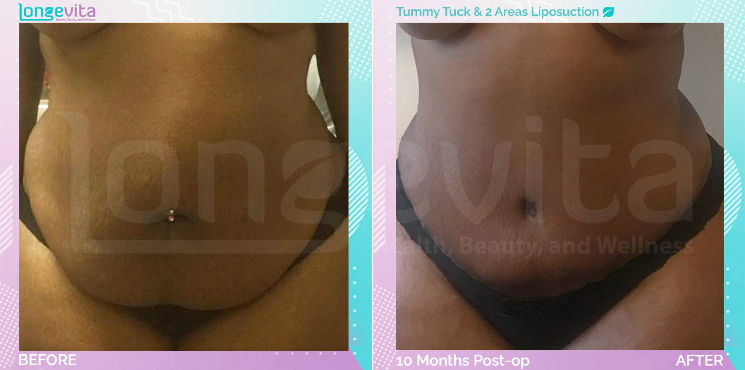 Liposuction and Tummy Tuck before and after, Body