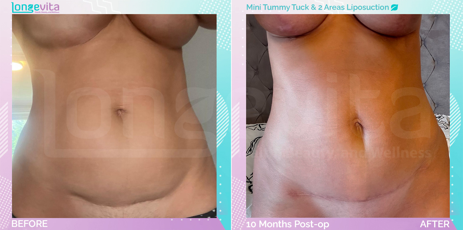 Liposuction and Tummy Tuck before and after, Body, 30s female patient