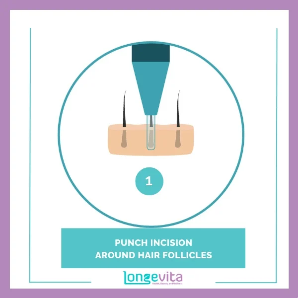 1 PUNCH INCISION AROUND HAIR FOLLICLES