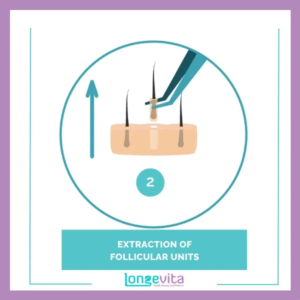2 EXTRACTION OF FOLLICULAR UNITS