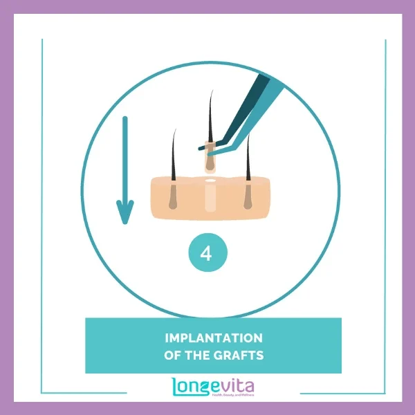 4 IMPLANTATION OF THE GRAFTS