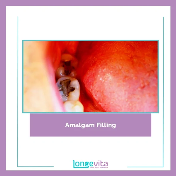 Amalgam Filling 1