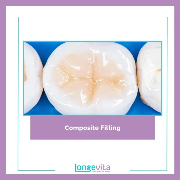 Composite Filling 1