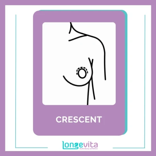 Crescent Breast Implant Incision