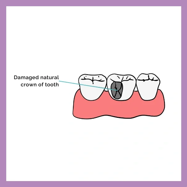 Dental Crown procedure 1