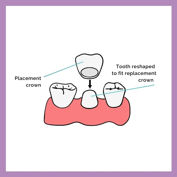 Dental Crown procedure 2