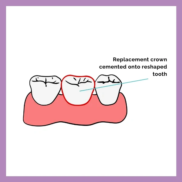 Dental Crown procedure 3