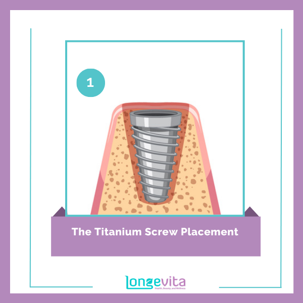 Dental Implants procedure step 1