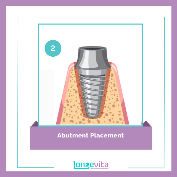 Dental Implants procedure step 2