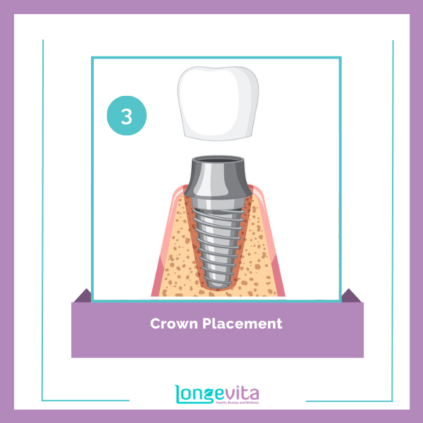 Dental Implants procedure step 3