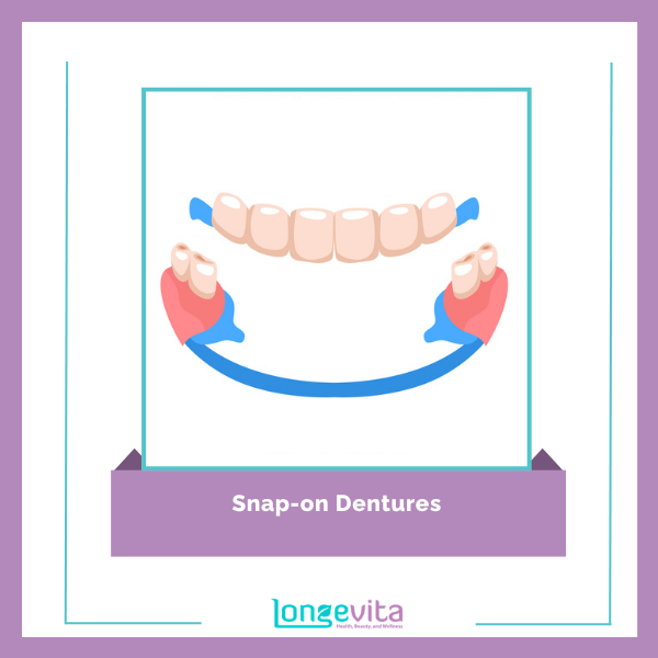 Dentures types 2