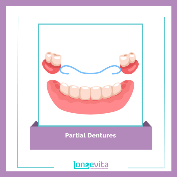 Dentures types 4