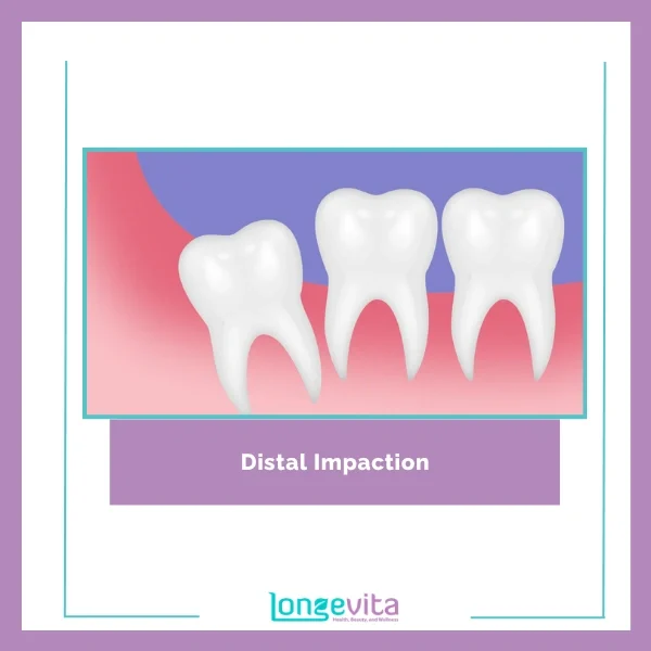 Distal Impaction Extraction