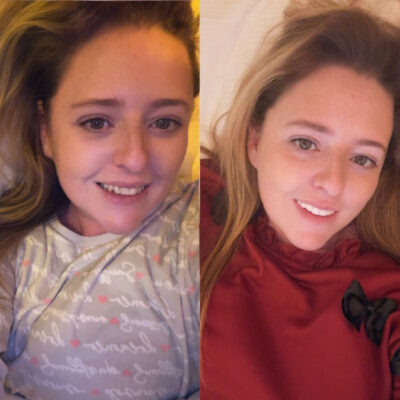 Gillian before and after the treatment 2