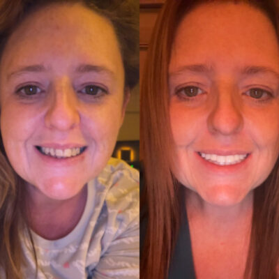 Gillian before and after the treatment