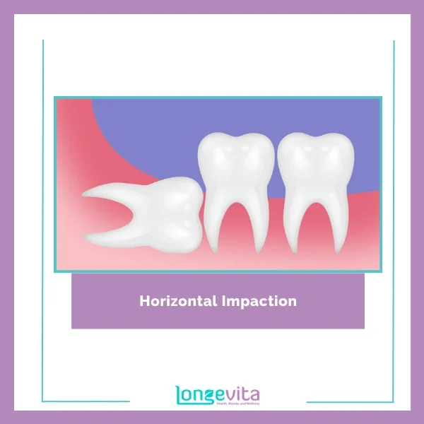 Horizontal Impaction Extraction