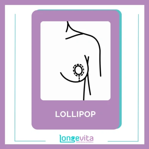 Lollipop Breast Implant Incision