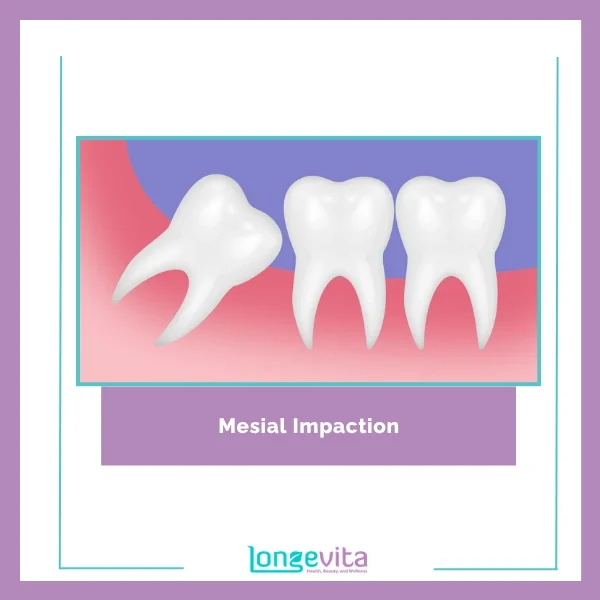 Mesial Impaction Extraction (2)