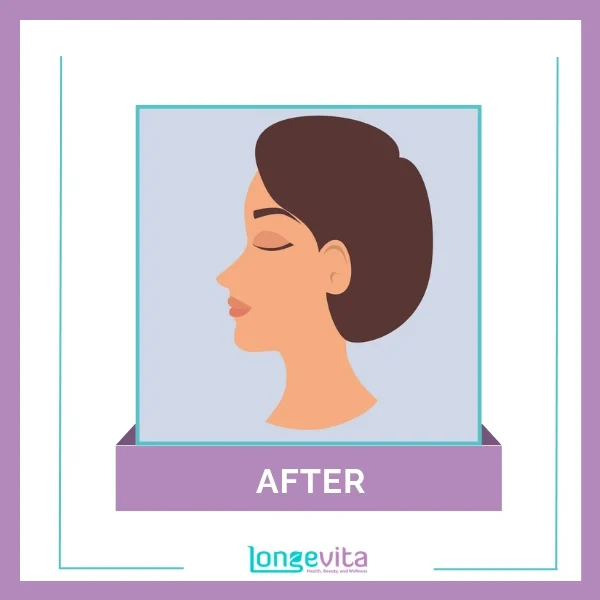 Non surgical nose job after