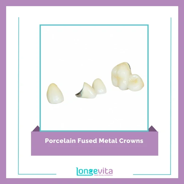 Porcelain Fused Metal Crowns